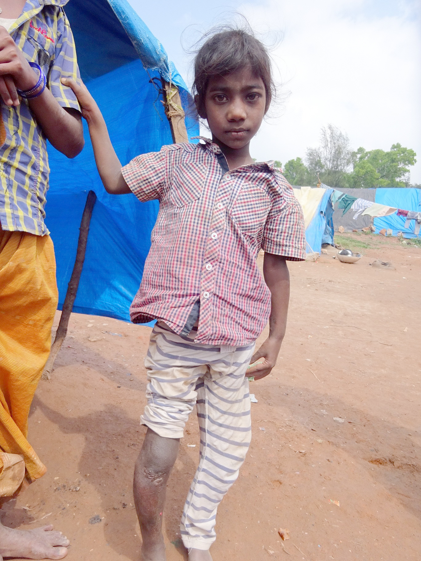 ಬಿದ್ದದ್ದು ಒಂದೇ ನೆಪ, ಈಕೆಯ ದೇಹವಿಡೀ ಕೀವು